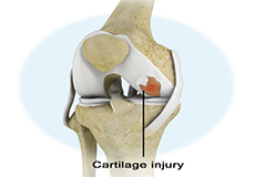 Cartilage Injuries